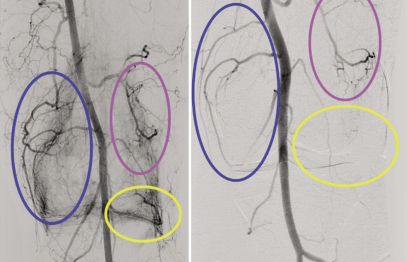 Stradiņa slimnīcā ieviesta moderna ārstēšanas metode hronisku locītavu sāpju mazināšanai 